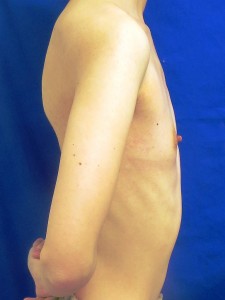 ③術前　右側面